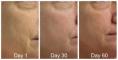 Before After Co2 Laser Skin Resurfacing Skin Rejuvenation San Antonio
